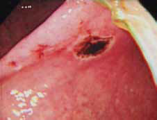 尿道カテーテルによる対側の胃粘膜潰瘍形成