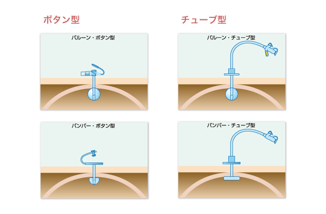 胃ろうの種類