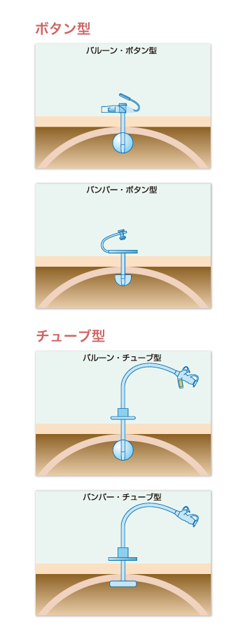 胃ろうの種類