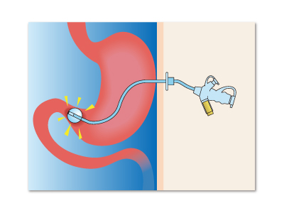 尿道カテーテルによる対側の胃粘膜潰瘍形成