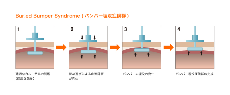 内部バンパーが胃壁内に埋もれている