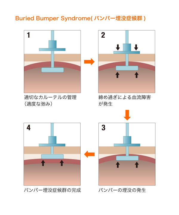 内部バンパーが胃壁内に埋もれている